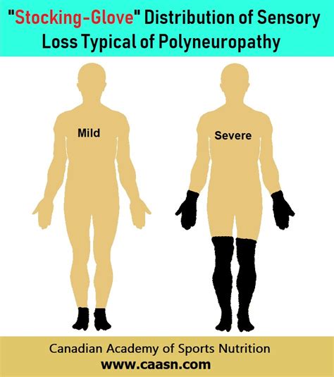 stocking glove syndrome|Small Fiber Neuropathy: Symptoms, Treatment,。